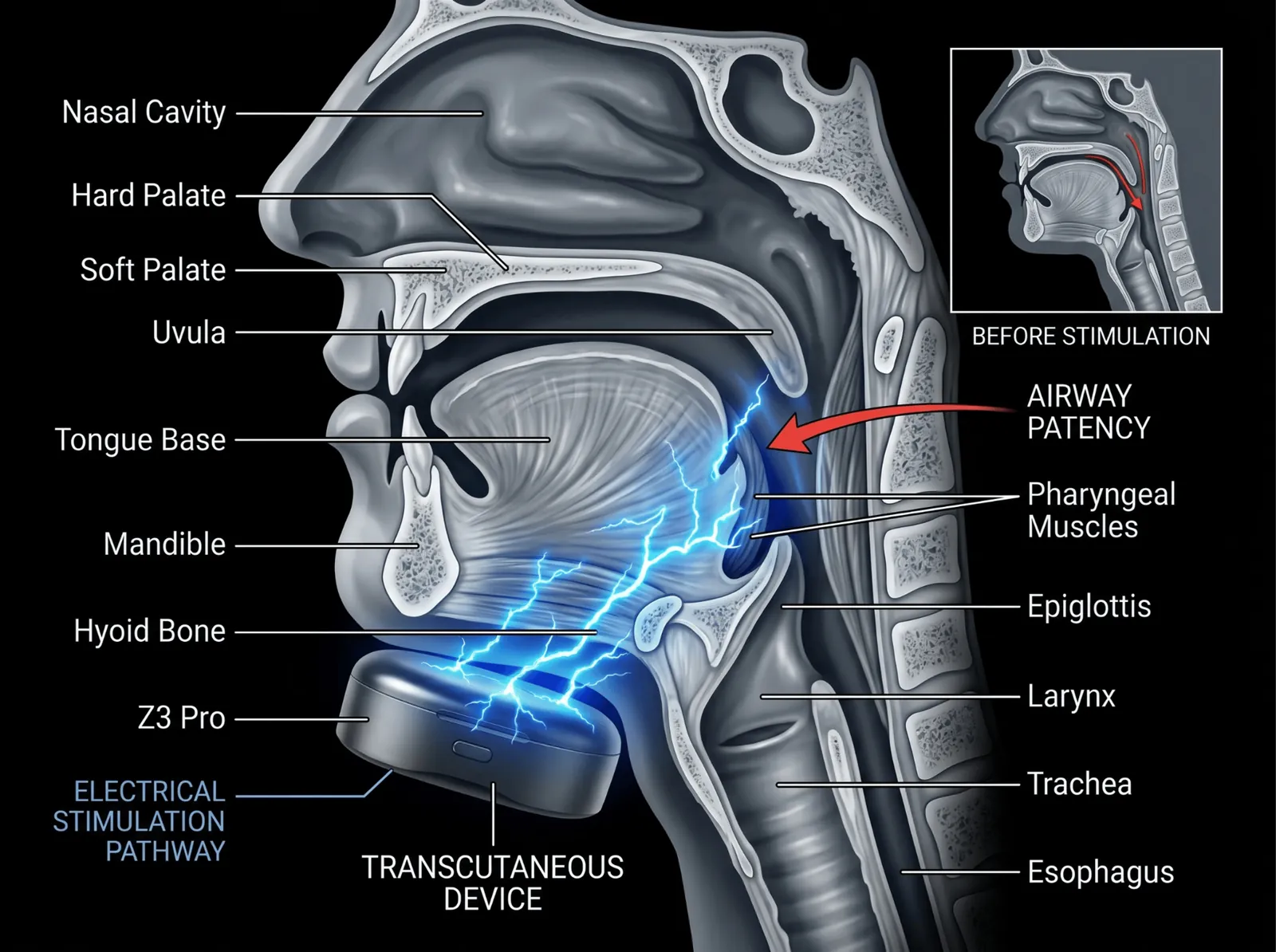 Z3 Pro device on a thin patch under the jaw, soft natural light